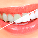 Отбеливание зубов megadent